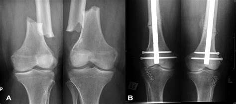 The Outcome of Surgically Treated Femur Fractures Associated... : Journal of Trauma and Acute ...