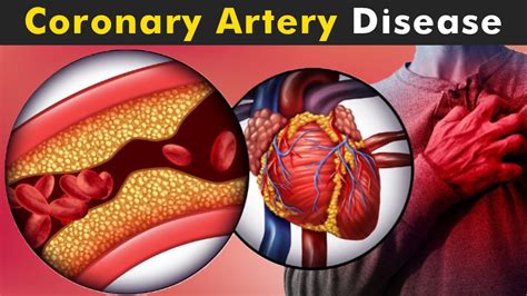 Coronary Artery Disease Symptoms