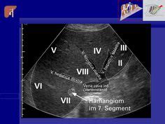 Couinaud’s Liver Segments – Sonographic Tendencies | Segmentation ...