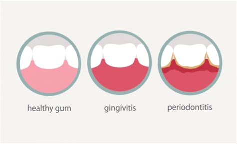 How to Treat Gum Disease and Gingivitis – RiseWell