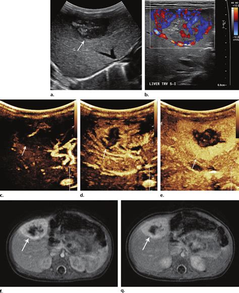 Rapidly involuting congenital hemangioma in a 39-day-old boy in the... | Download Scientific Diagram