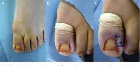 الظفر الناشب في القدم Ingrown-toenail | الدكتور مازن كردية