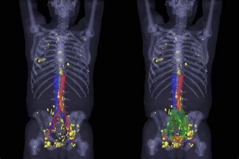 PSMA PET/CT Visualizes Prostate Cancer Recurrence Early, Impacts ...