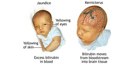 Kernicterus - www.medicoapps.org