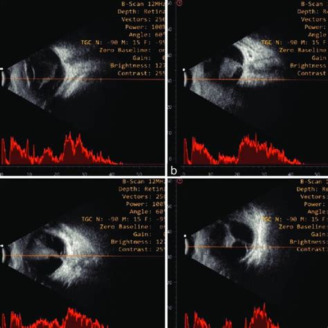 Presenting features for diagnosis of Terson syndrome | Download ...