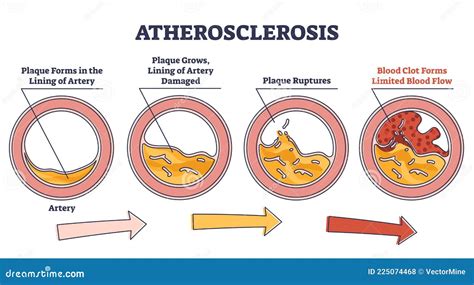 Atherosclerosis Stages