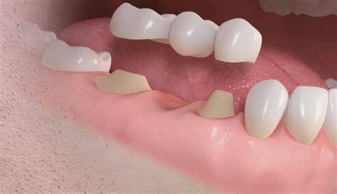 Puentes Fijos | DentalVital