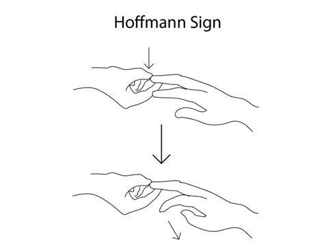 Hoffmann Sign - StatPearls - NCBI Bookshelf