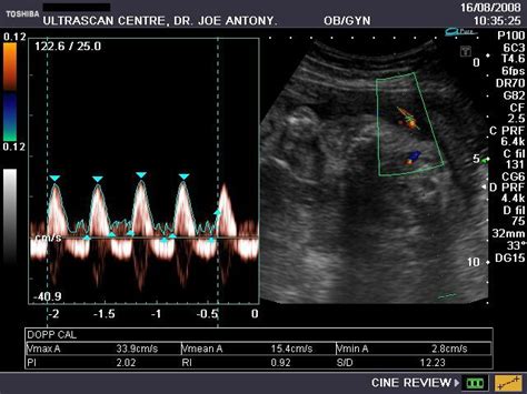 Doppler of Umbilical Artery Ultrasound Services in Ernakulam, Ultrascan Centre | ID: 8454062030