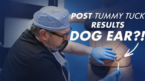 Post Tummy Tuck Results - Dog Ear - YouTube