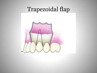 Flaps in oral surgery | PPT