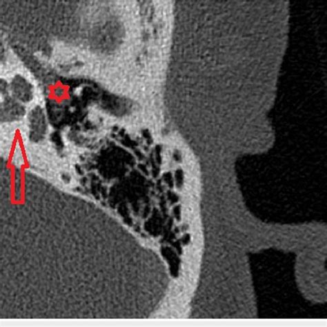 The histology of middle ear paraganglioma (light microscopy) Arrow ...