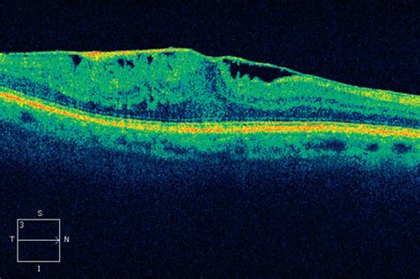 Epiretinal Membrane Oct