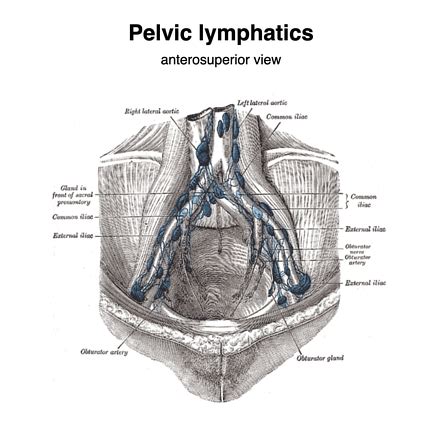 External iliac lymph nodes | Radiology Reference Article | Radiopaedia.org