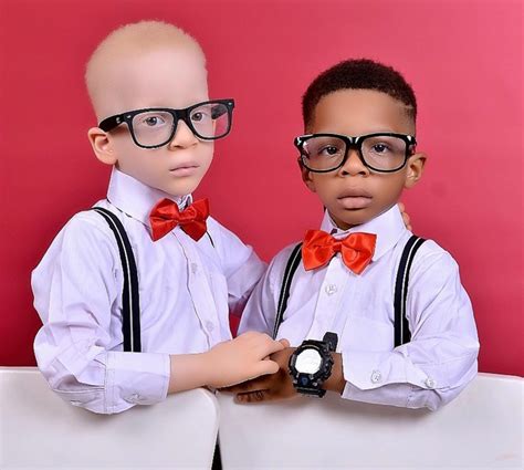 Twins - One With Albinism, One Without - Are Best Friends