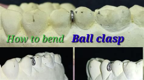 How To Make Adams Clasp In Orthodontics at Harvey Worthy blog