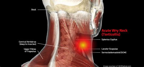 Wry Neck – Parkdale Osteopathic Clinic