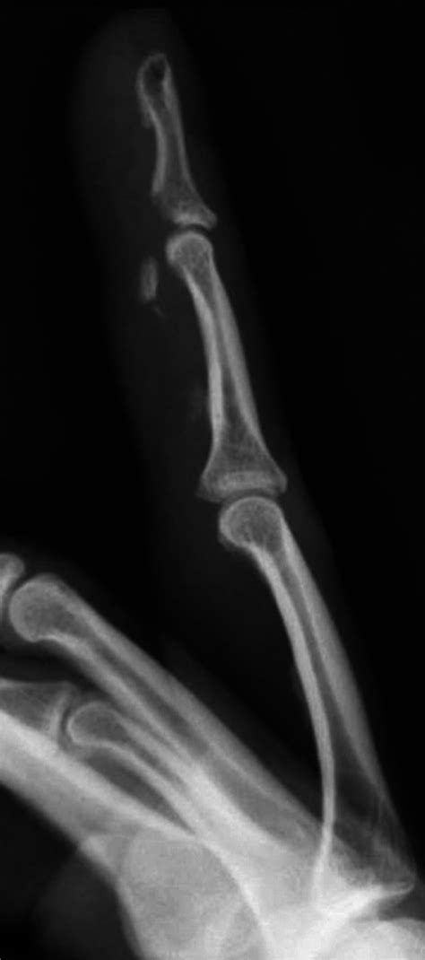 Fig. 4.3, [Jersey finger with avulsion fracture...]. - Musculoskeletal Diseases 2021-2024 - NCBI ...