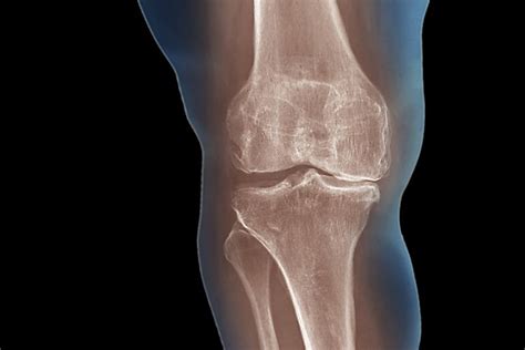 Causes and Treatment of Degenerative Arthritis