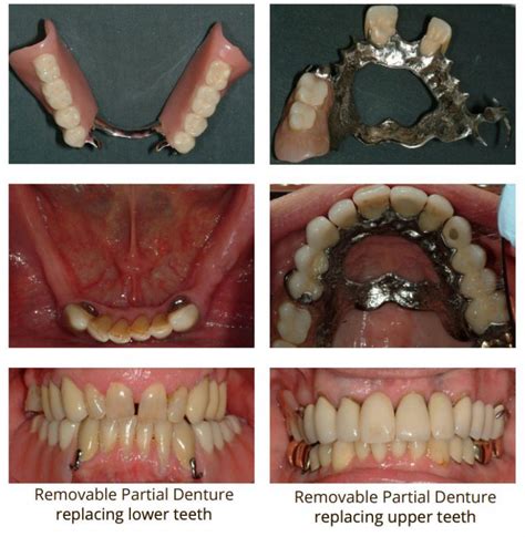 Dental Implants vs Partial Dentures | Eau Claire Park Dental