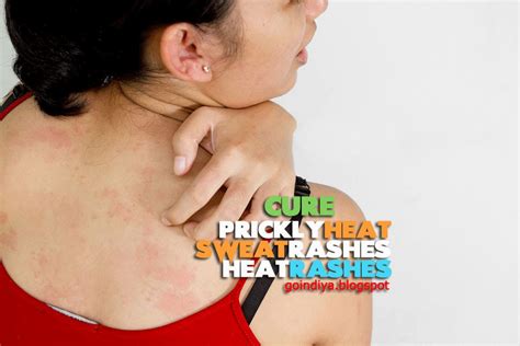 26 Natural Home Remedies for Prickly Heat, Sweat Rashes, Heat Rashes ...