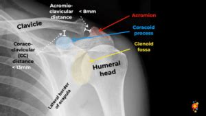 Clavicle fractures