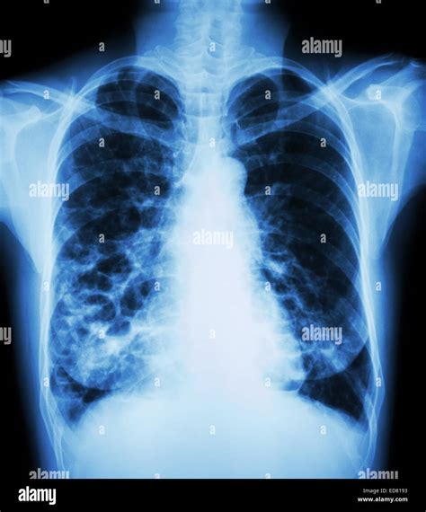 "Bronchiectasis" X-ray chest show : multiple lung bleb and cyst due to ...