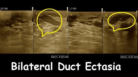 Bilateral duct ectasia | Breast Report | Amader hospital | Ultrasound ...