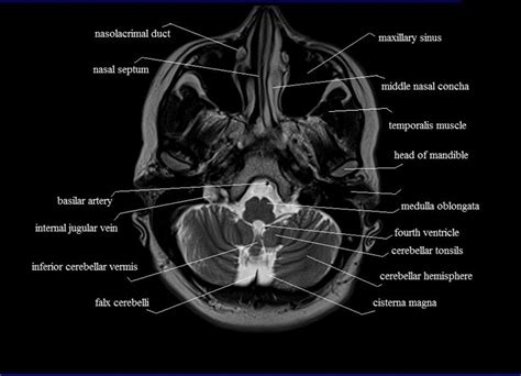 MRI anatomy | free MRI axial brain anatomy | Brain anatomy, Mri, Anatomy