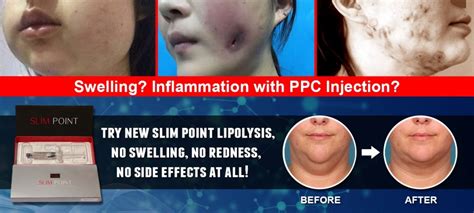 New lipodissolve solution Slim Point Lipolysis Injection compares to Lipo Lab PPC