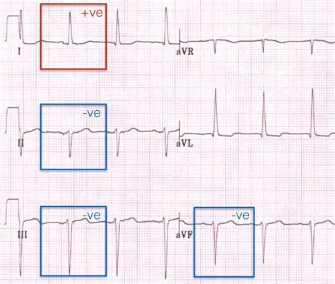 Right Axis Deviation Ecg - Simple Education / The mean qrs axis during the first 4. - das-ca