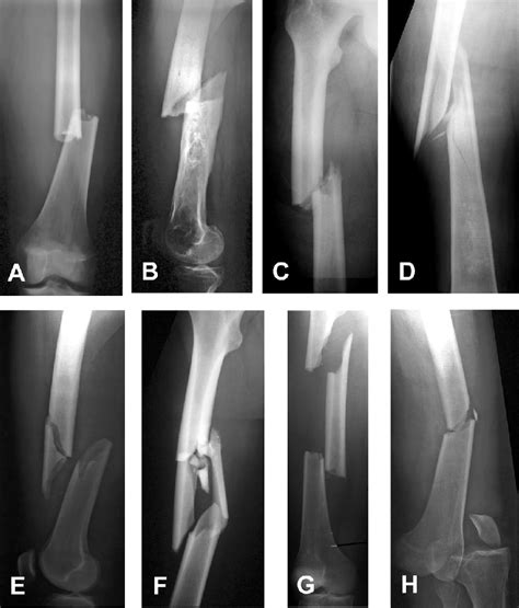 Different morphologic types of femoral shaft fractures: A. A simple... | Download Scientific Diagram