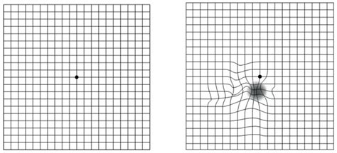 macular-degeneration-amsler-grid - Chatswood Eye Specialists