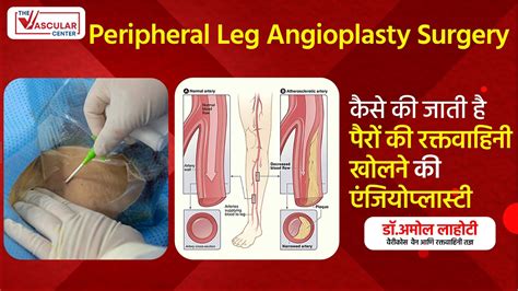 Leg Angioplasty | Gangrene treatment | Improving Blood Flow and Alleviating Pain | Dr. Amol ...