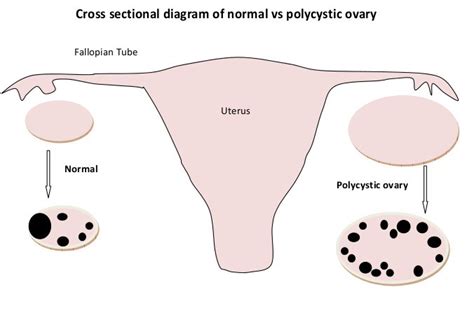 Polycystic Ovaries - Sydney Ultrasound for Women