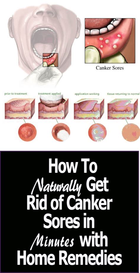 Home Remedies for Canker Sores