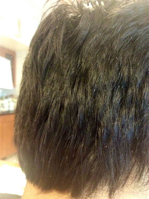 seborrheic dermatitis hair loss permanent - Had A Fat Podcast Photography