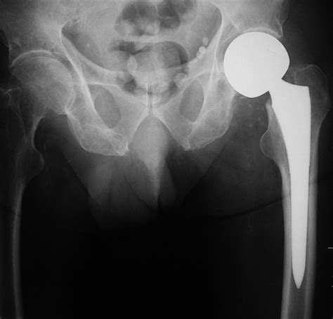 Medical Apparatus Imaging Guide: joint arthroplasty