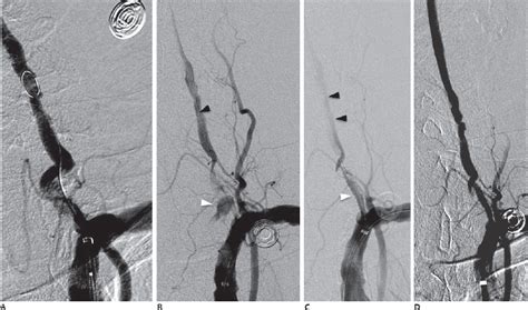 Management of Vertebral Artery Origin Stenosis | Neupsy Key