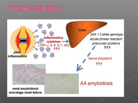 Renal amyloidosis