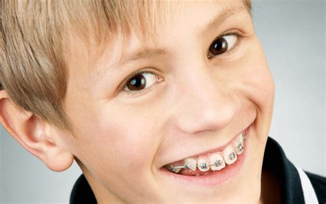 Braces for Children: What Are the Basics? | Academy Dental