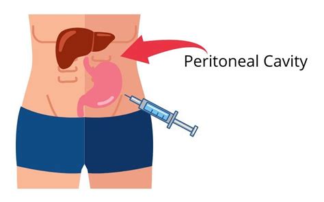 Intraperitoneal injection - Wikiwand