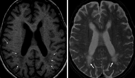 white matter disease mri Mri lesions diffuse axial - Diseases Club center