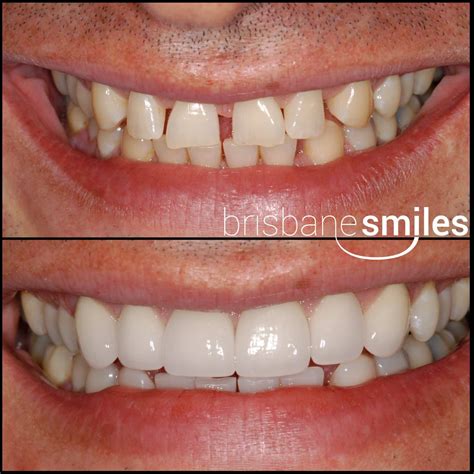 Porcelain Veneers - Brisbane Smiles