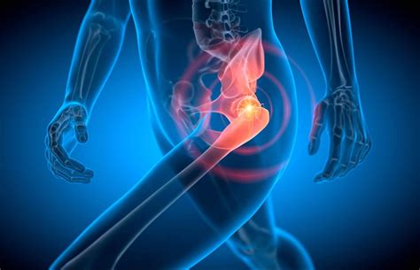 Hip Bursitis | Diagnosis, Treatment, and Recovery