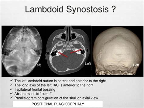 A Radiological Approach to Craniosynostosis