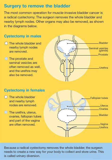 Bladder Cancer: Treatment for bladder cancer - Cancer Council