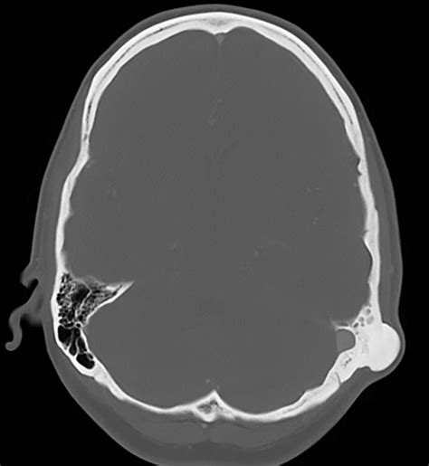 Imaging Spectrum of Calvarial Abnormalities | RadioGraphics