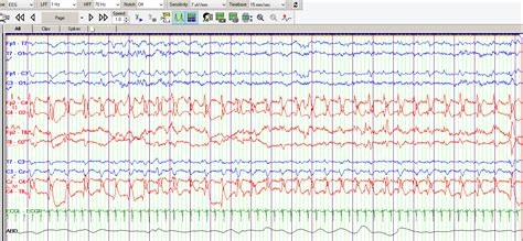 Neonatal Seizures | Neonatal Seizure Registry