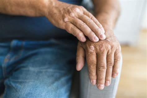 Psoriatic Arthritis: Causes, Symptoms, and Treatment - Orthopaedic ...